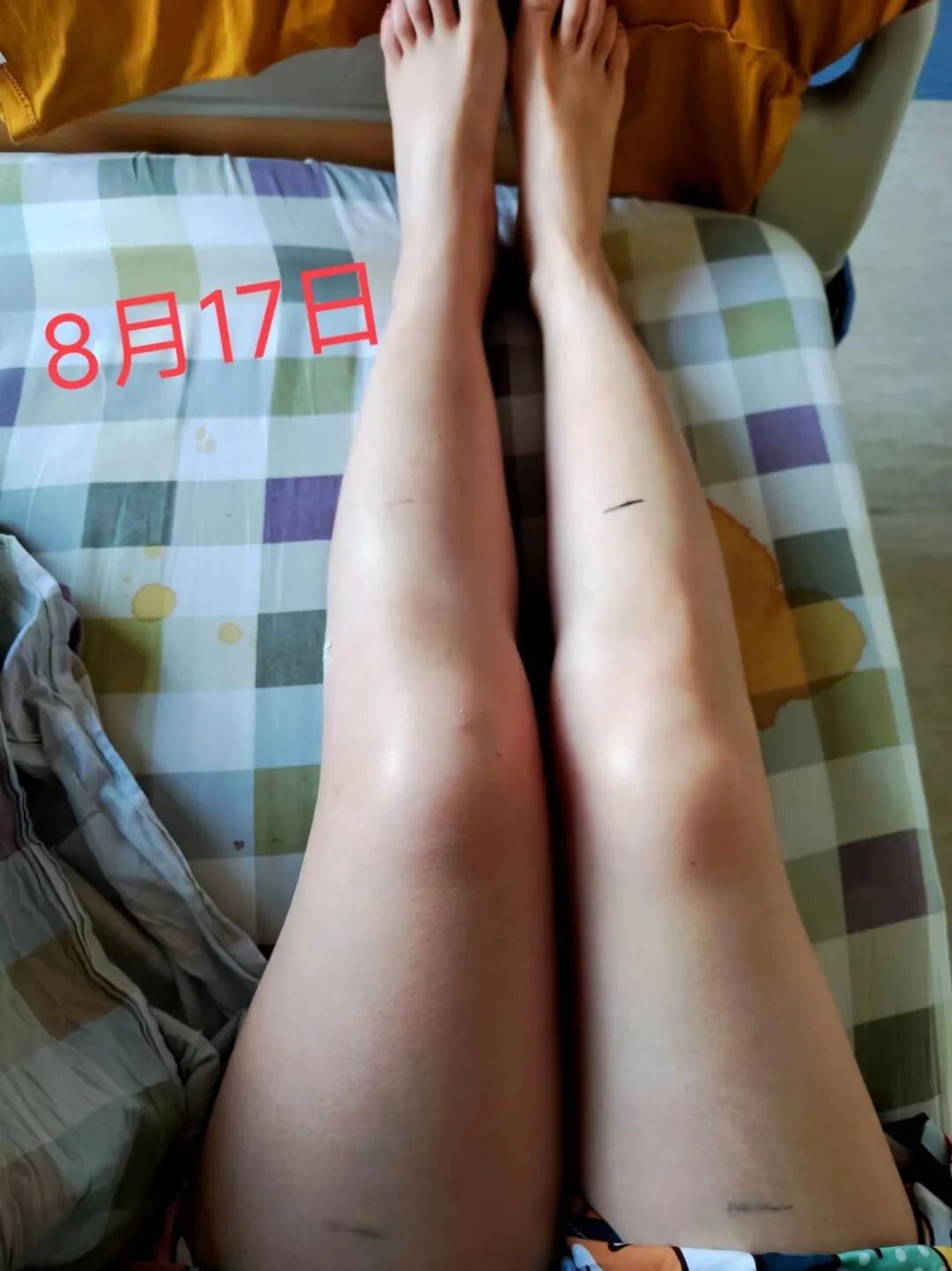 “看看,大腿、小腿、胯部、腹部全都是栓子,静脉快堵死了”