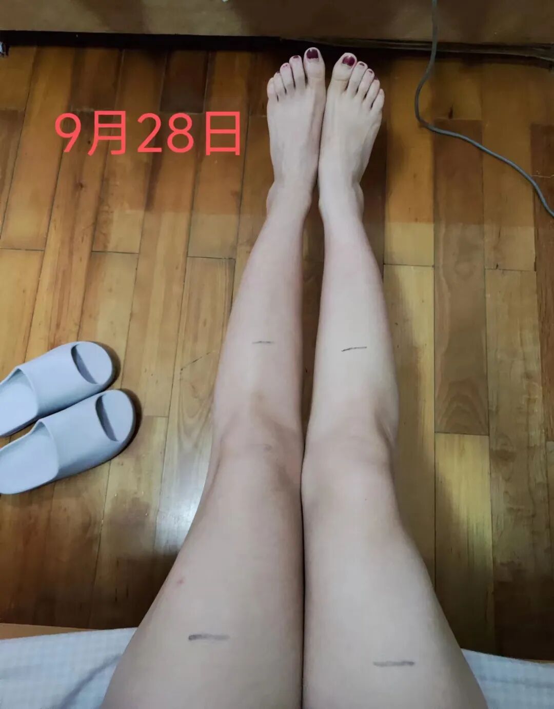 “看看,大腿、小腿、胯部、腹部全都是栓子,静脉快堵死了”