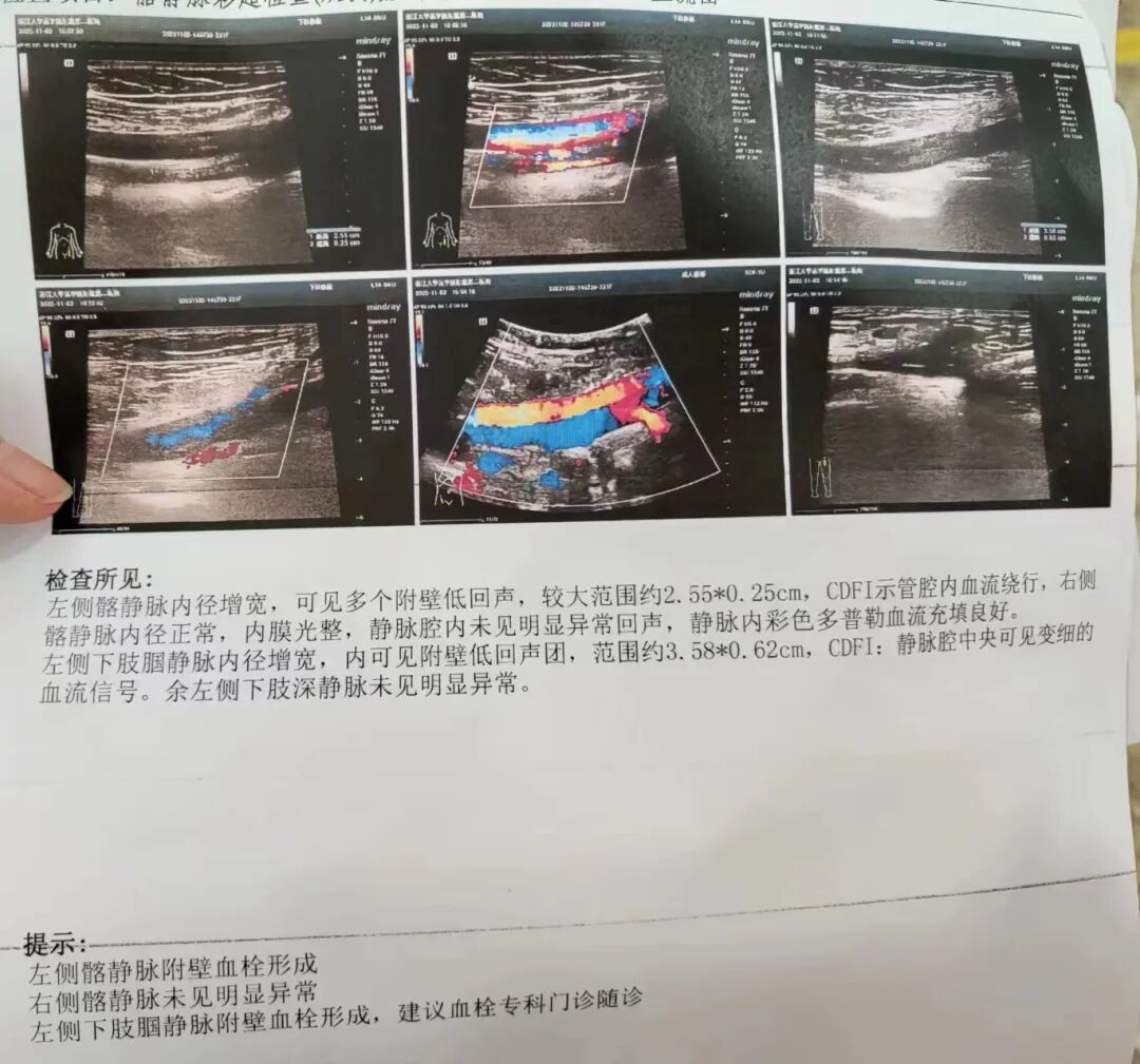“看看,大腿、小腿、胯部、腹部全都是栓子,静脉快堵死了”