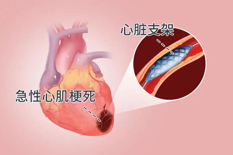 国内将逐渐停止“心脏支架”的手术？做完人就废了？真相来了