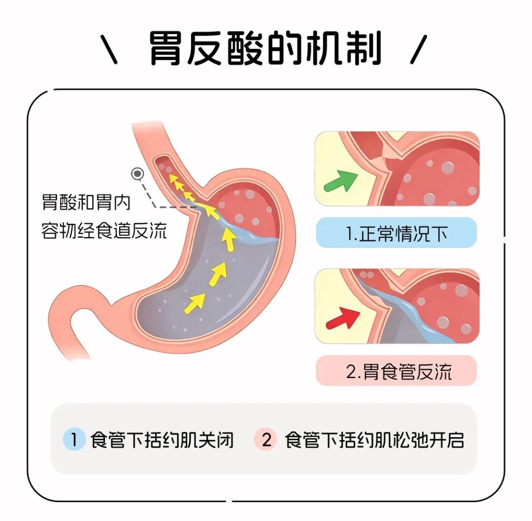 胃癌来临“静悄悄”?饭后这个现象,可能是身体最后的“警告”