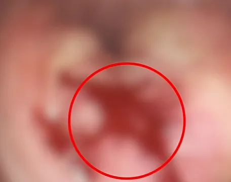 哥哥确诊癌症晚期无法手术，44岁弟弟陪诊后怕去检查，竟也查出癌症！医生提醒这类人尽快筛查