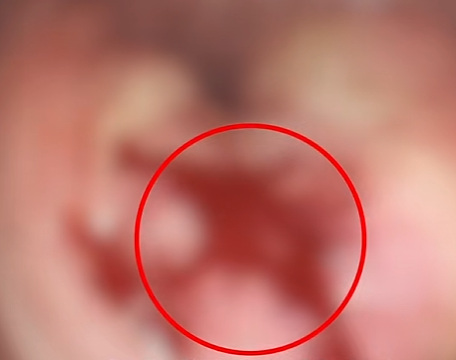 男子确诊癌症晚期，无法手术！44岁弟弟陪诊后怕了，主动检查也确诊癌症，却术后一周就出院；医生：这类人尽早筛查……