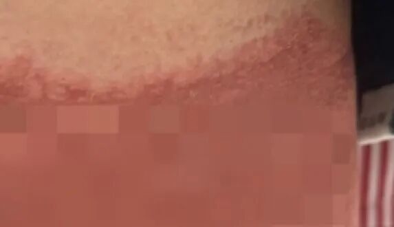 多名孩子下腹部出现红肿、脱皮、灼烧痕迹，就像被烫过一样，原因竟是家长洗短裤多做了一件事；医生紧急提醒