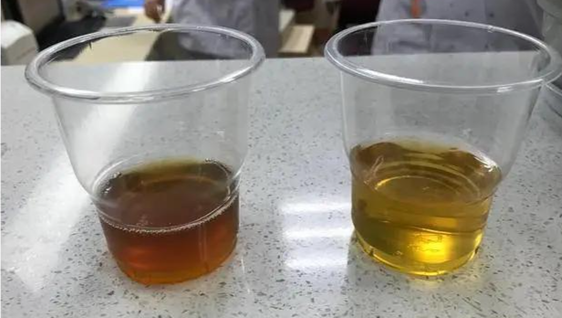 发病快、易重症！这个儿科病“重男轻女”！一粒蚕豆就让娃进ICU